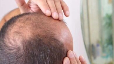 گنج پن میں مبتلا افراد کیلئے بڑی خوشخبری، علاج دریافت